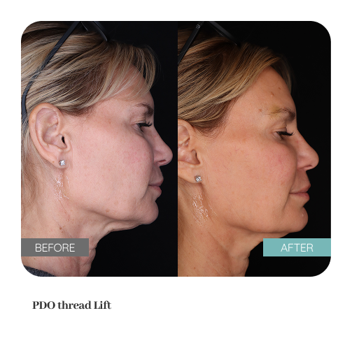 Before and after treatment result — Dr. Lanna, LC Medical Aesthetics NYC